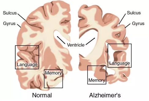 AD药物研发明状：：：辉瑞、礼来、百健、诺华、强生……