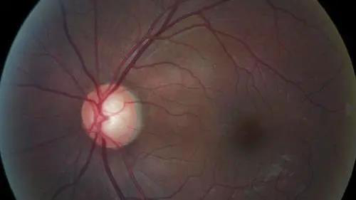 青光眼的克星来袭，，，助力患者远离视力的“窃贼”