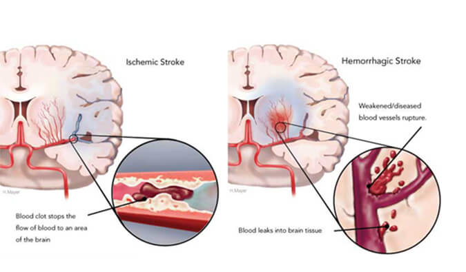 天下卒中日：：：从动物药效模子评价看心脑血管药物开发